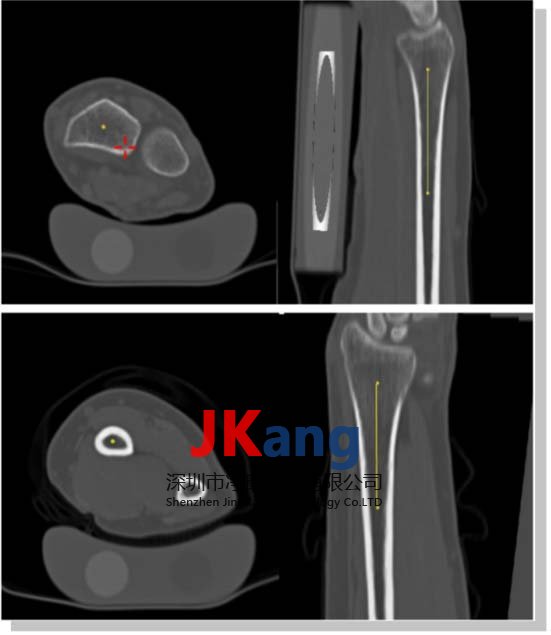 QRM-BMF 前臂模型,Forearm Phantom (BMF)前臂模體